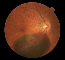 網膜下血腫の眼底写真